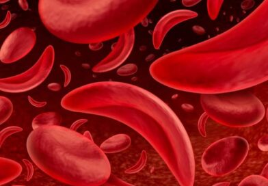 Anemia falciforme provoca dor crônica e afeta a qualidade de vida